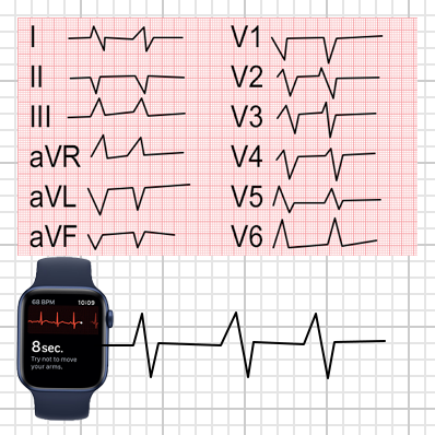 ECG standard à 12 dérivations et ECG des montres Apple