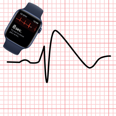 Syndrome de Brugada et montres ECG Apple